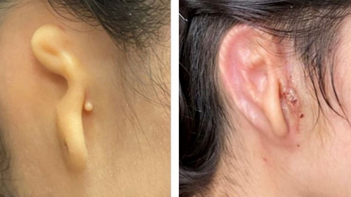 Udana transplantacja ucha Fot. Microtia-Congenital Ear Institute and 3DBio Therapeutics